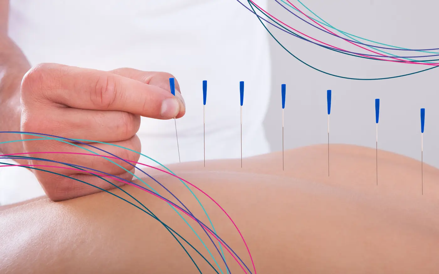 Acupuncture